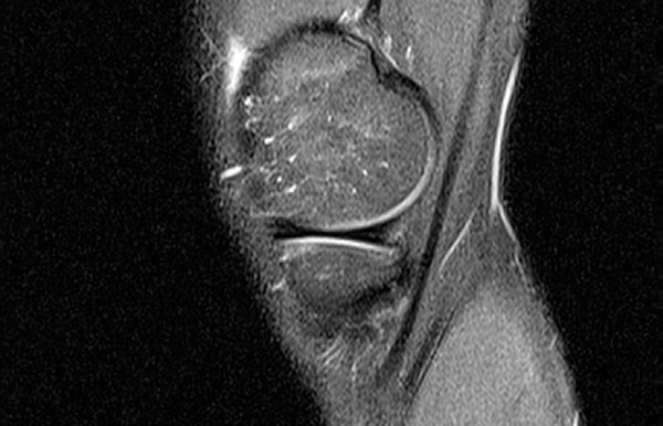 МРТ коленного сустава