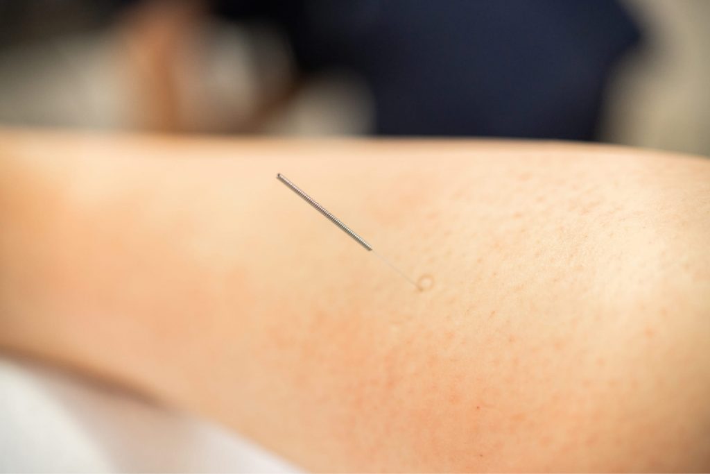 Dry needling – метод сухой иглы в Астане