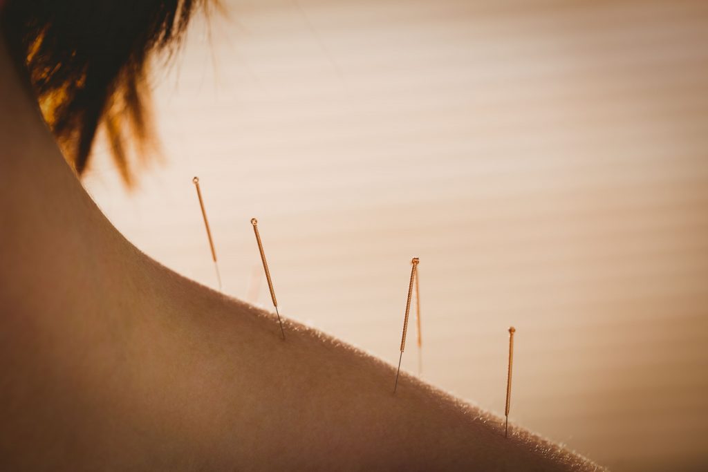 dry needling в Астане